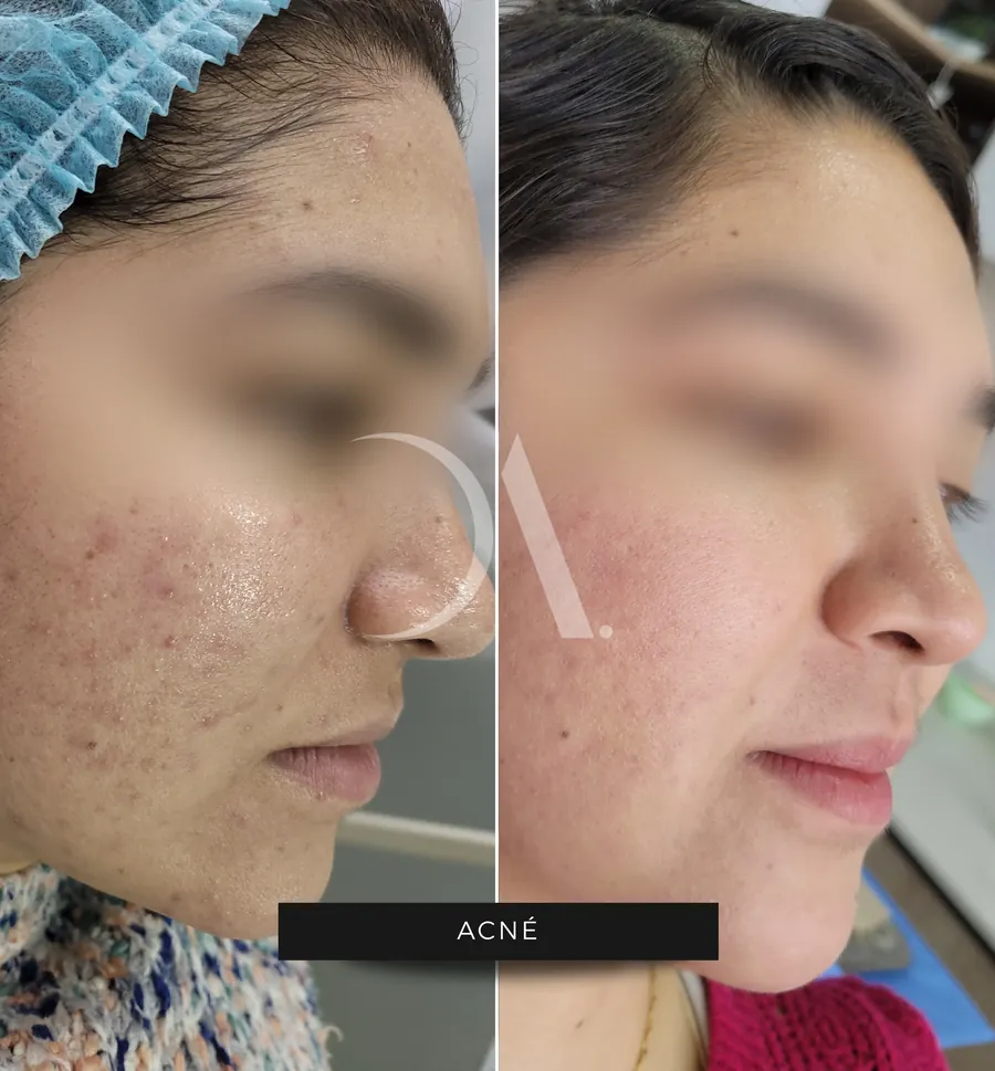 Antes y después de tratamiento para el acné