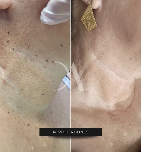 Antes y después de remoción de acrocordones