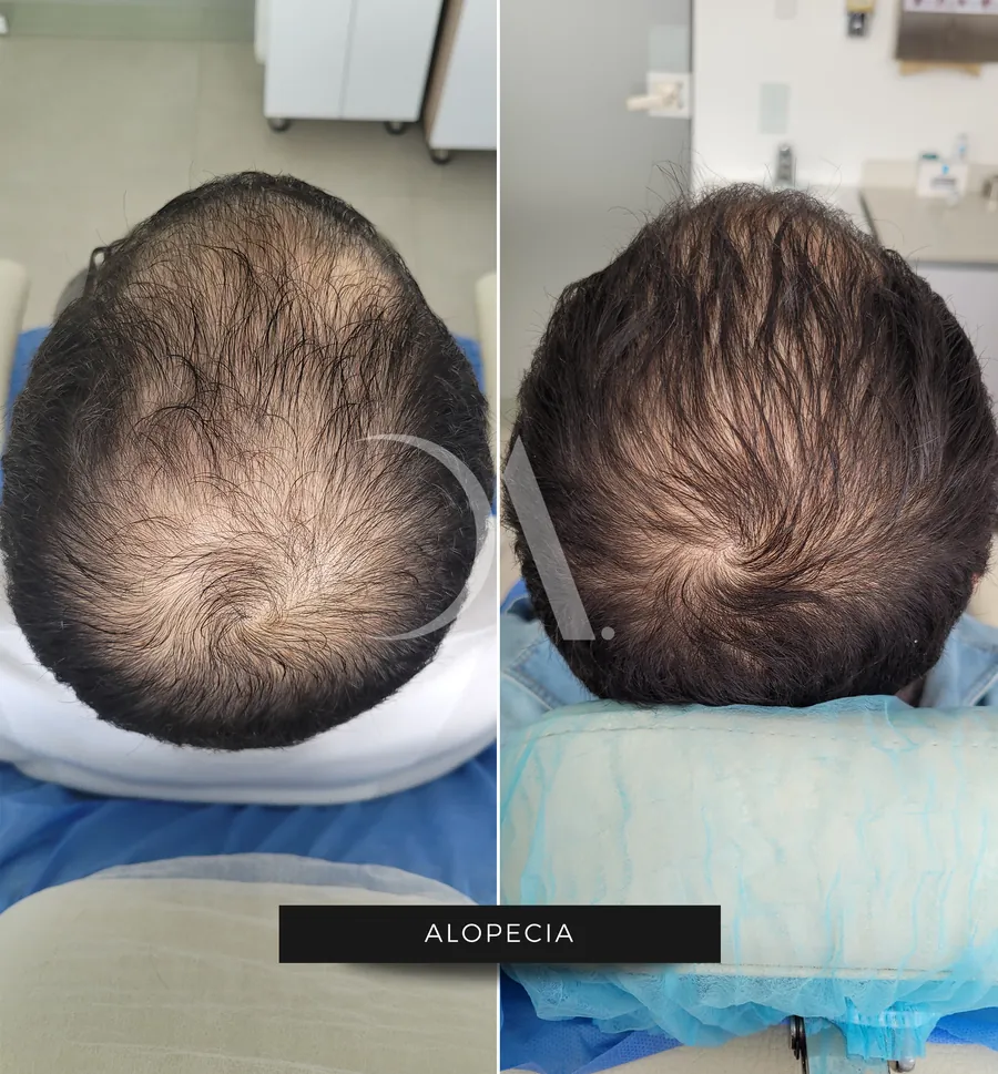 Antes y después de tratamiento para la alopecia
