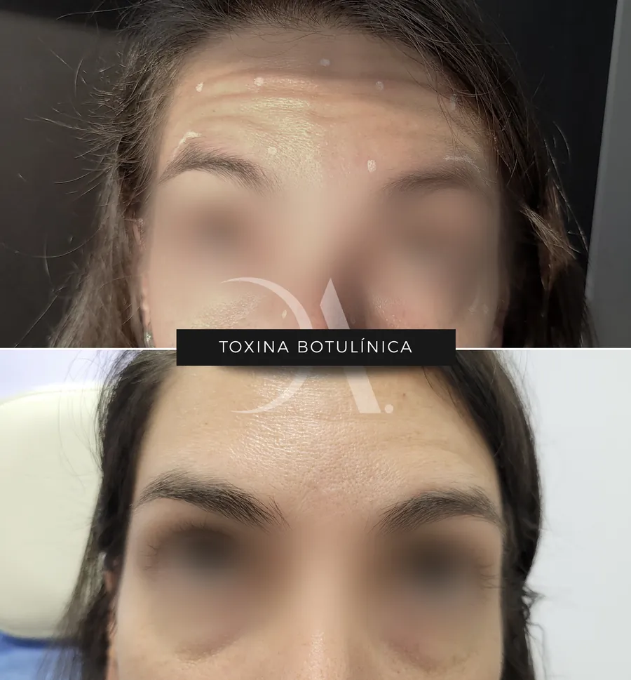 Antes y después de aplicación de toxina botulínica